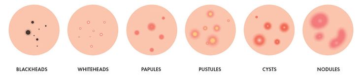 how to treat the different types of acne